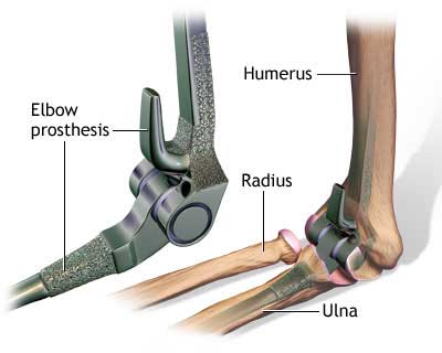 elbow arthroplasty in vizag