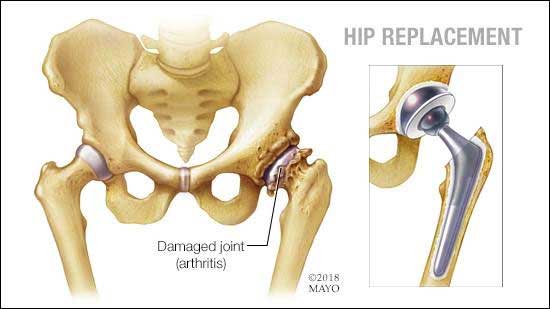 hip arthroplasty in vizag