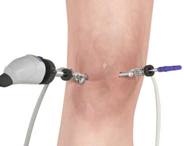 knee arthroscopy in vizag