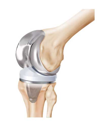 knee replacement in Vizag